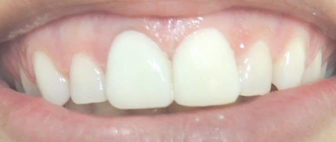 Lente de contato em dente escuro