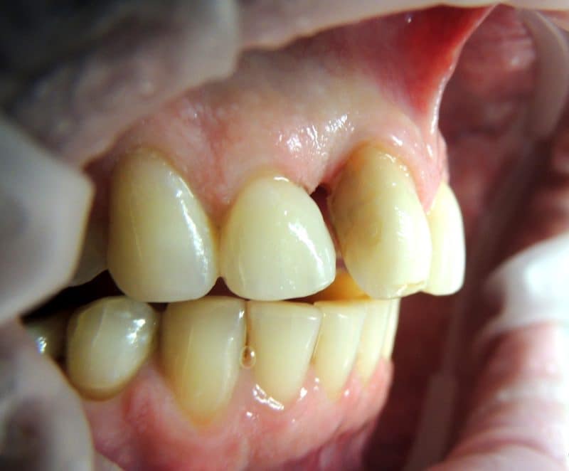 Tratamento de Periodontia