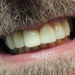 Dentes com lente de contato