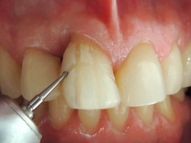 Procedimento de desgastes para aplicação de Faceta