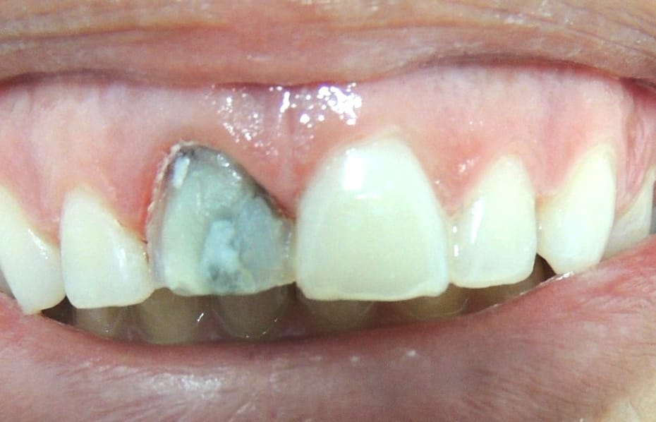 Dente escuro caso clínico